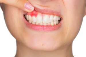 GINGIVITIS ATAU PERIODONTITIS