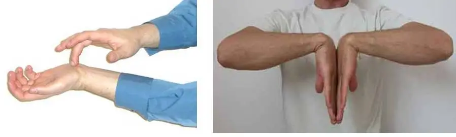 Carpal Tunnel Syndrome